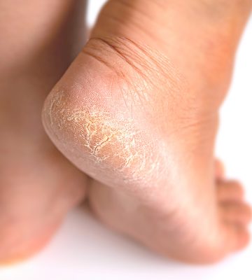 Close up of a heel with a callus that is causing cracks to form.