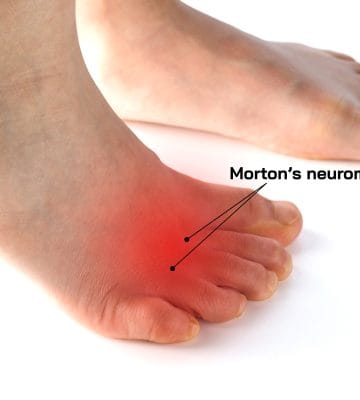 Foot showing Morton's neuroma.