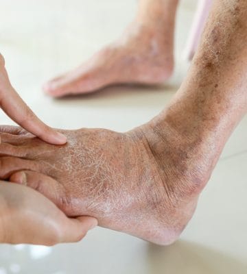 Close up of a podiatrist inspecting diabetic foot problems.