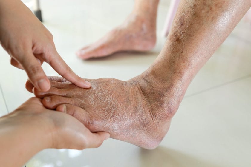Close up of a podiatrist inspecting diabetic foot problems.