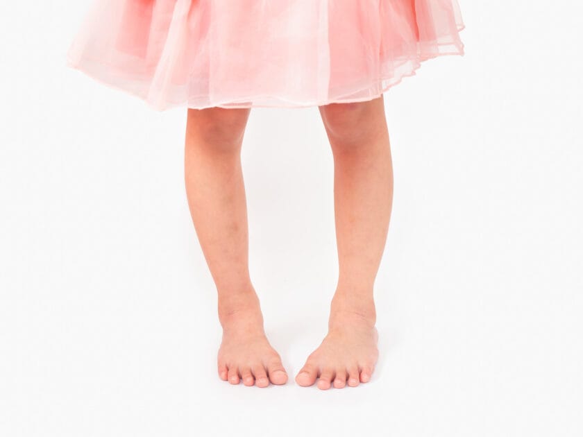 Legs of a young child with symptoms of intoeing.
