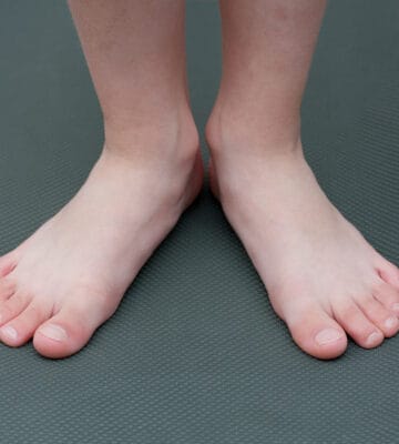 Close-up of child's foot displaying out-toeing.